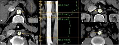 Reference values of normal abdominal aortic areas in Chinese population measured by <mark class="highlighted">contrast-enhanced computed tomography</mark>
